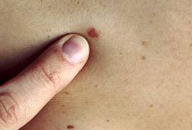 13. maijā – eiromelanomas dienā varēs pārbaudīt ādas veselību