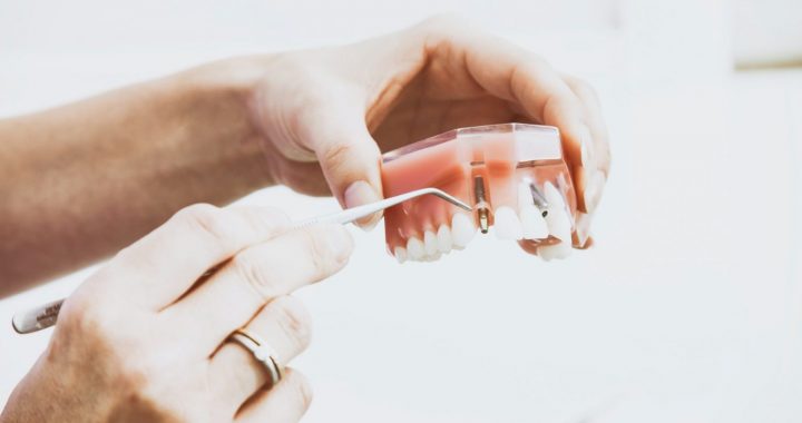 Septiņi visbiežāk uzdotie jautājumi par zobu implantiem