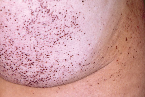 Mazi, sarkanīgi violeti punktiņi uz ādas – retas slimības pazīme